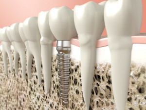 Our Berkeley, CA area patients know that dental implants make a better treatment for missing teeth than dentures.