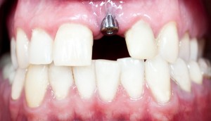 Our Berkeley, CA area patients know that the dental implant process can leave them with beautiful replacement teeth.