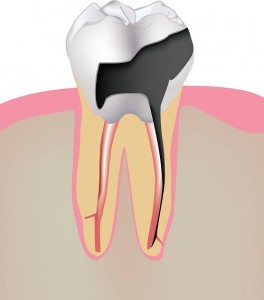 Our Berkeley, CA area patients know that they can restore the damage done by tooth decay with dental implants. 